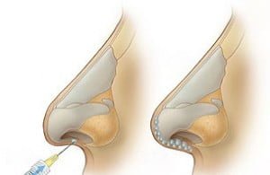 ameliyatsiz_burun_estetigi