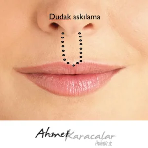 Lip and Mouth Contour Rejuvenation Lip-suspension