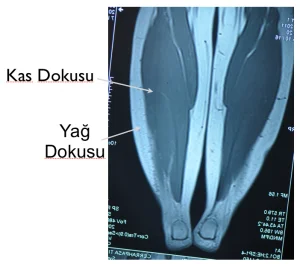 ترقيق الساق السميكة