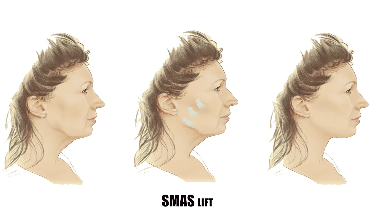 Lifting SMAS para el estiramiento facial: resultados naturales y duraderos.