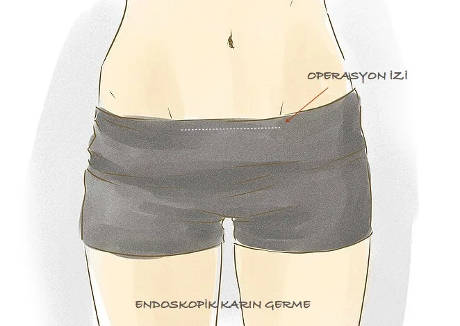 الجزء السفلي من جسم شخص يرتدي شورت داكن اللون، مع أثر جرح أفقي باهت فوق حزام الخصر. تُظهر العلامات التركية "أثر الجرح" و"شد البطن بالمنظار". - البروفيسور الدكتور أحمد كاراجالار