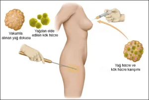 meme-uvelichenie-stvolovaya-kletka