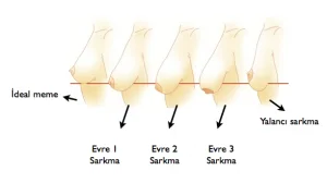 обвисание-груди