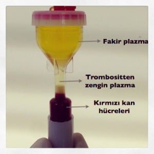 Trombosit Enjeksiyonları-PRP prp