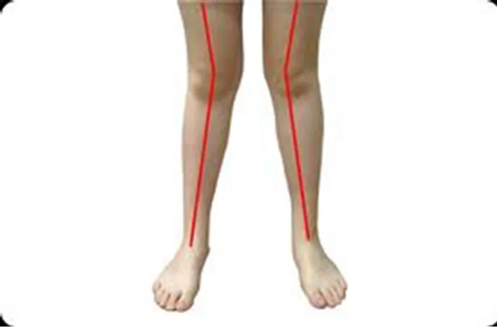 Esthétique des jambes en X