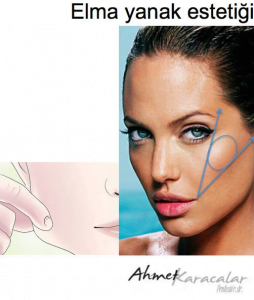elma-yanak-estetiği