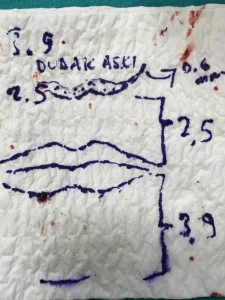 Lip and Mouth Contour Rejuvenation lip suspension