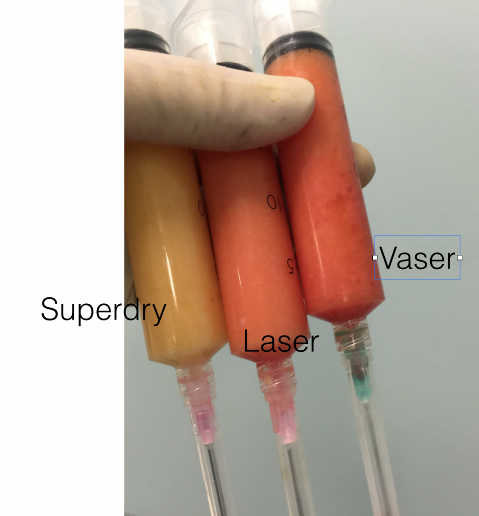 Superdry lipödem tedavisi