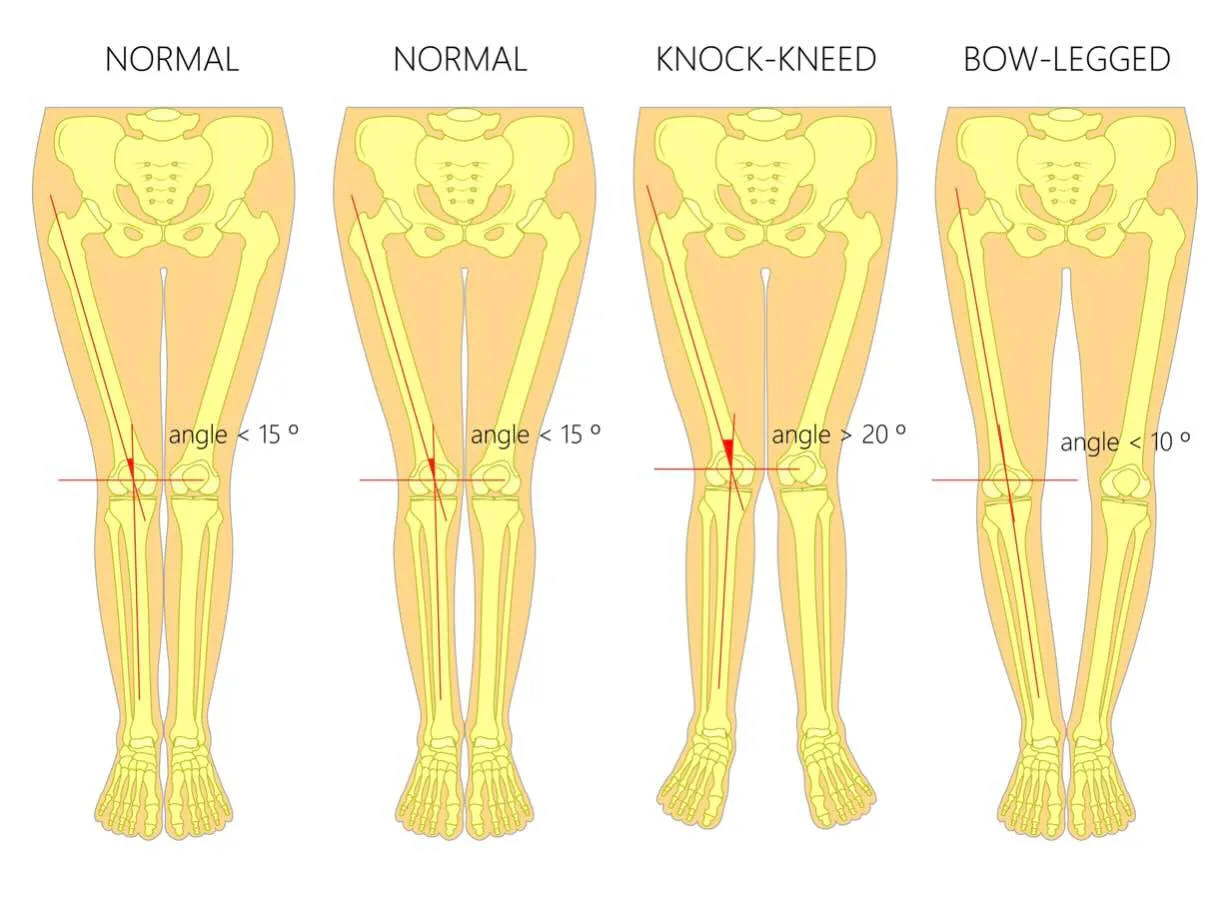 جراحة تجميل الساق: شكل الساق العمودي وفن SuperDry 4D قبل وبعد جراحة تجميل الساق