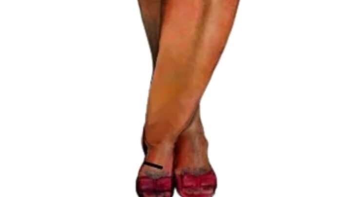 lipödem tedavisi nasıl olur