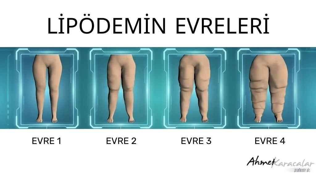 Lipödem tedavisi, evrelere göre değişen liposuction ve destekleyici yöntemleri gösteren medikal görsel.