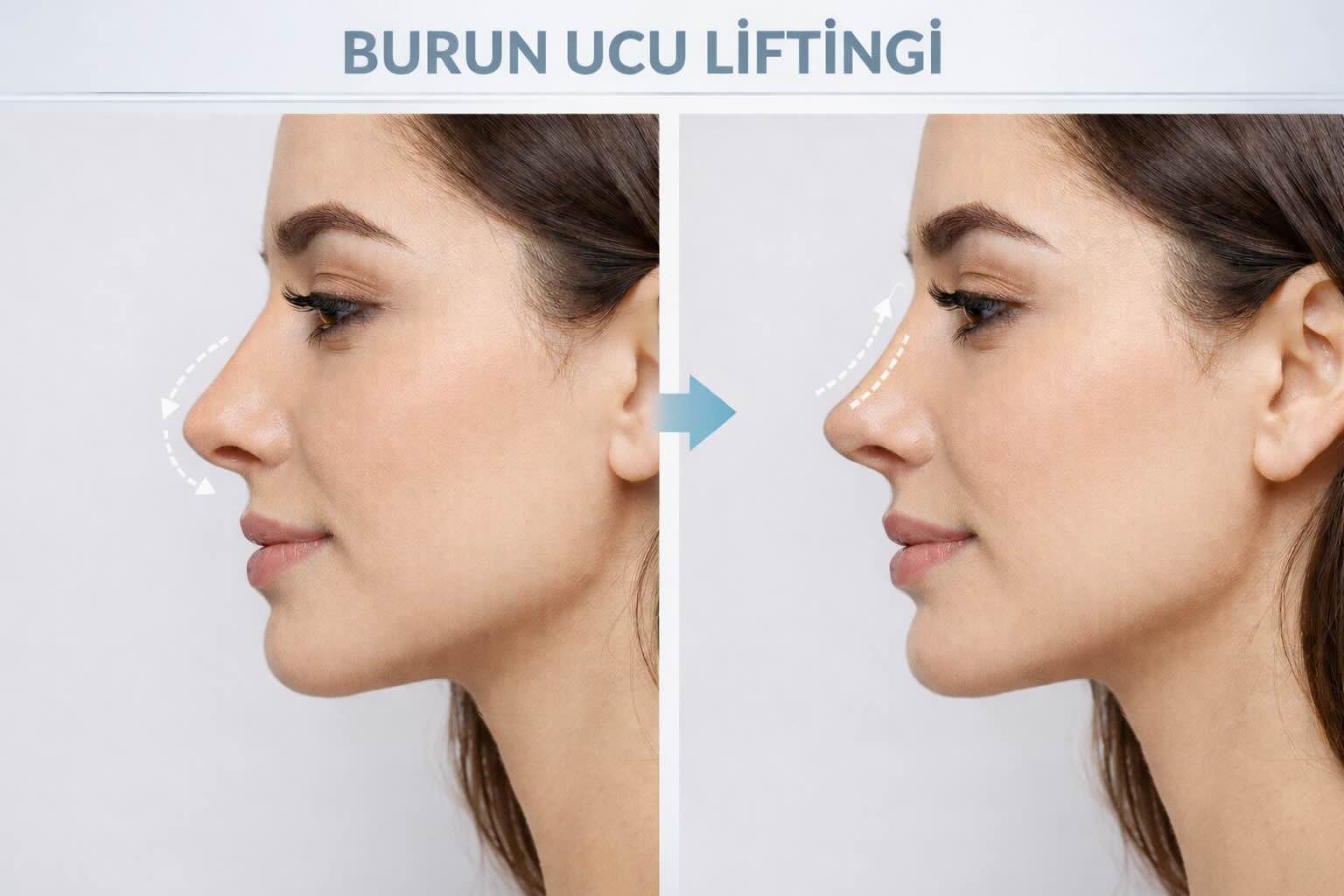 Burun ucu kaldırma ve lifting öncesi sonrası analiz görseli